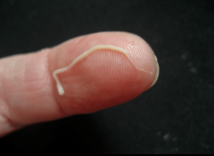 parasit buleud tina awak manusa